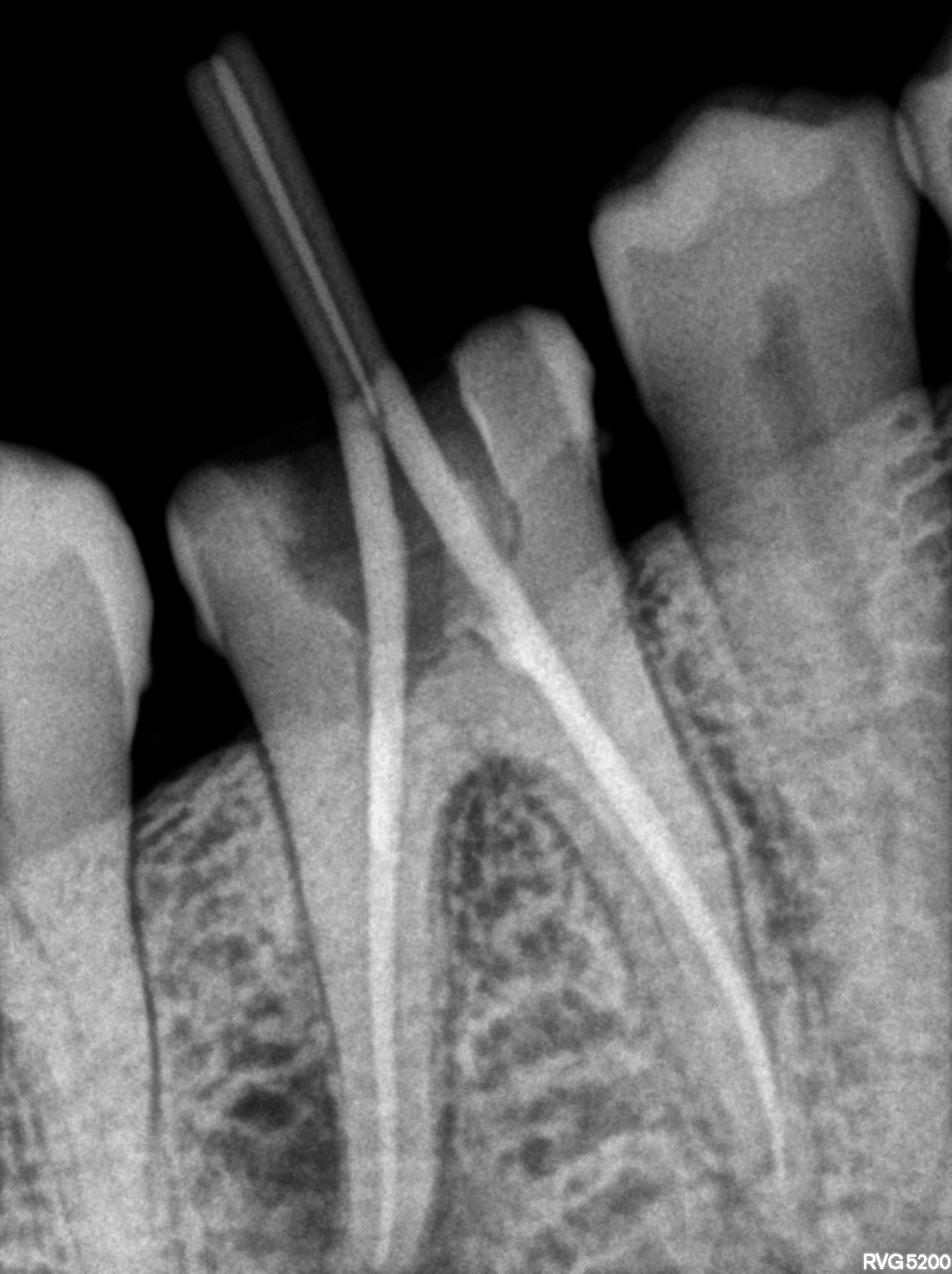 Dental X-ray